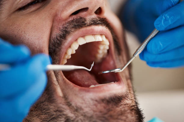 Best Emergency Tooth Extraction in Linglestown, PA